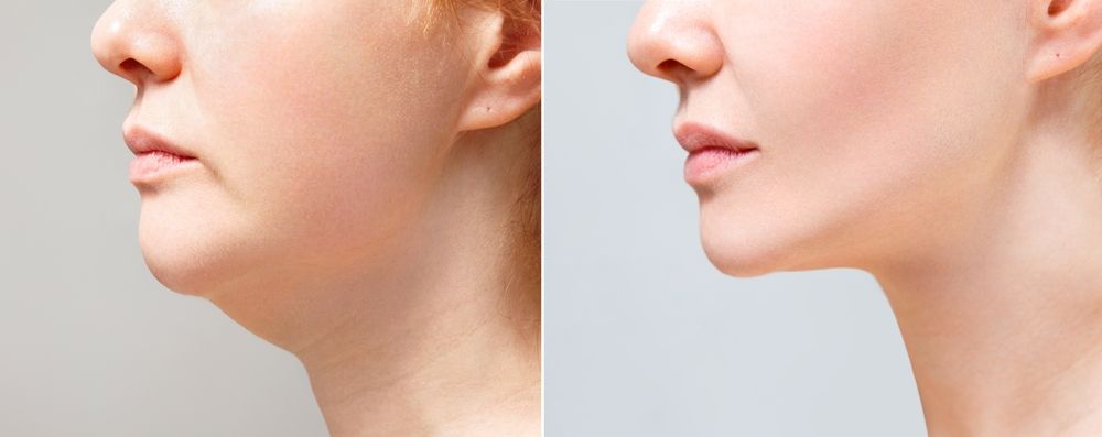Kybella Treatment for Double Chin in Dubai Maintenance Guide