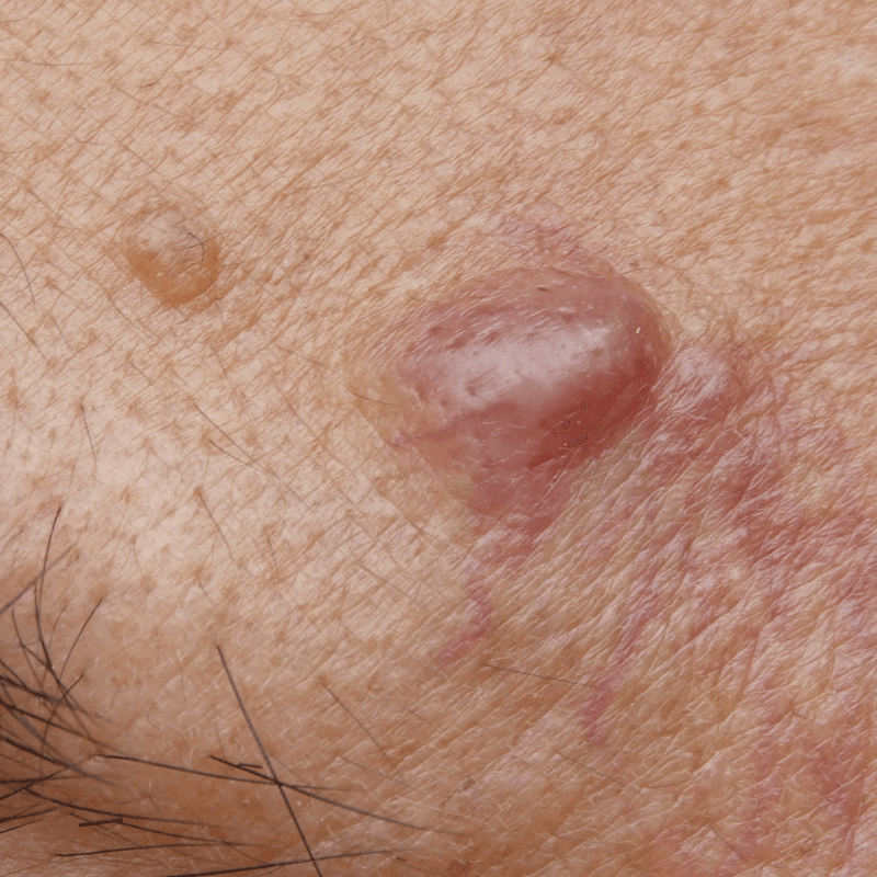 Lipoma Treatment and Complete Care Guide
