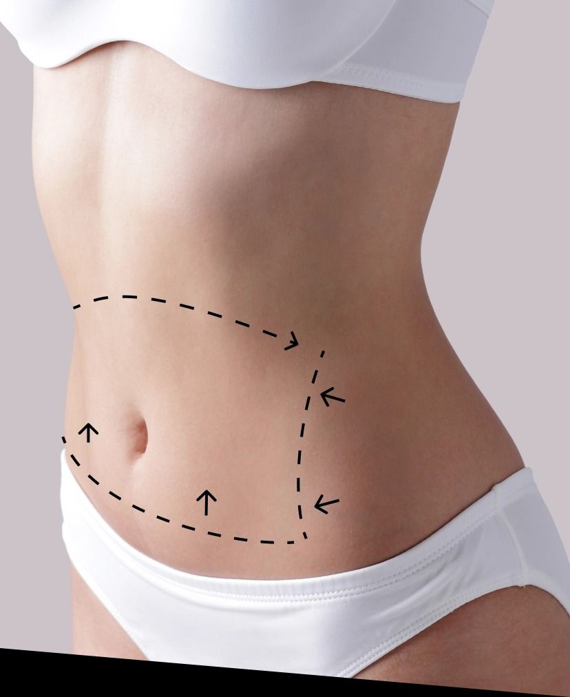 Liposuction in Islamabad: Creating a More Defined Waist and Body Profile