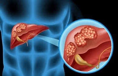 Liver Cancer Diagnostic Market 2022 Financial Facts by 2028
