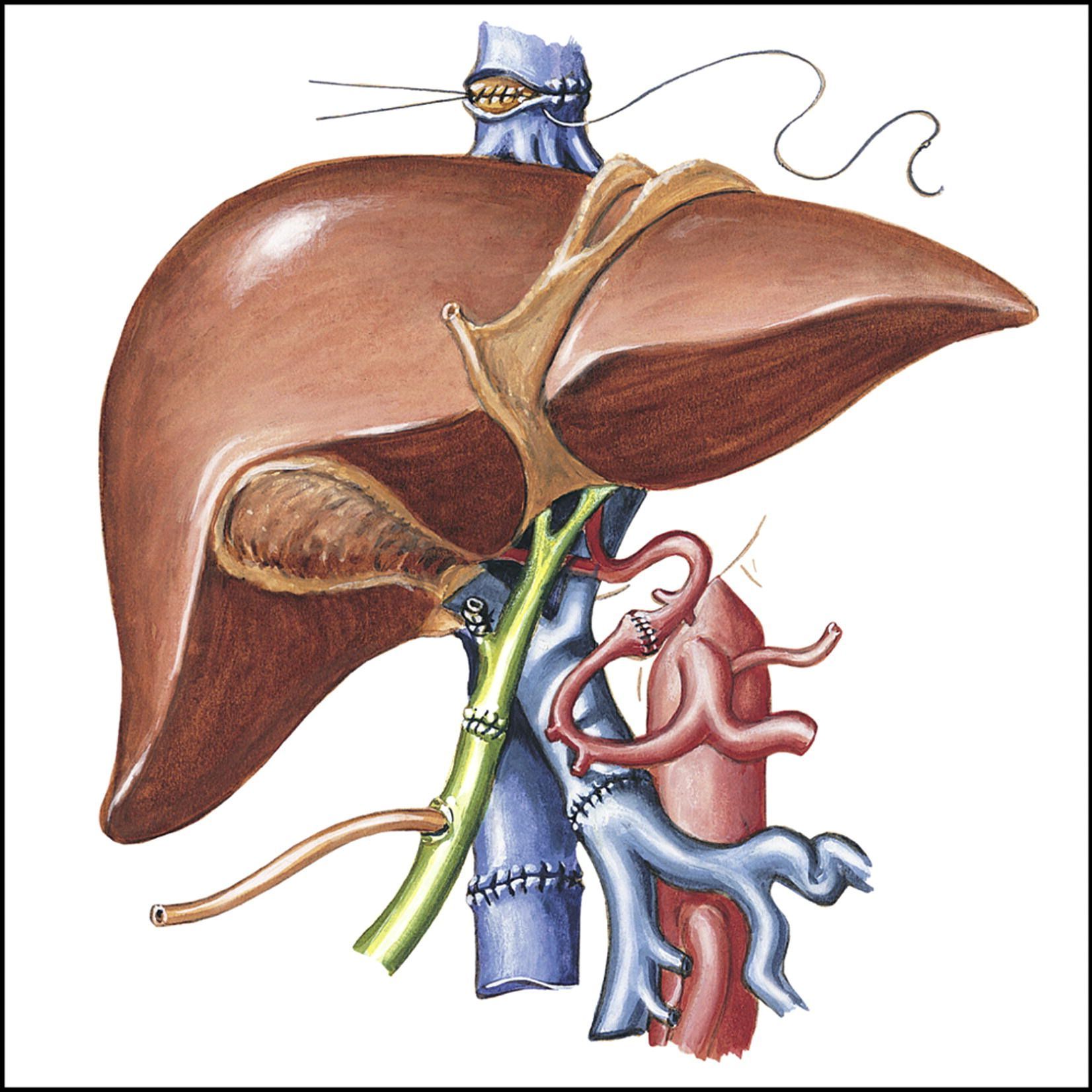Liver Transplantation Market Strategy, Segmentation Analysis 