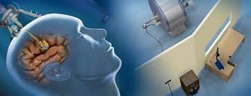 Mri Guided Neurosurgical Ablation Market Forecast to 2028
