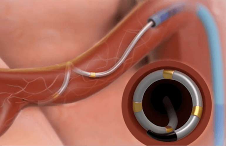 Renal Denervation Technologies Market 2022 – Sales 2030