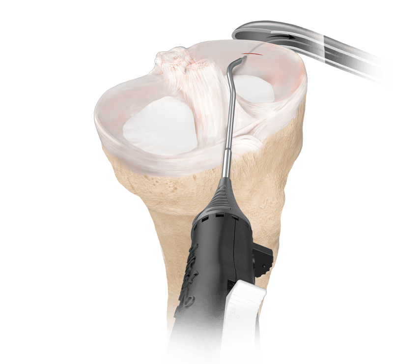 Meniscal Repair Systems Market 2022 Players Analysis Report 2028