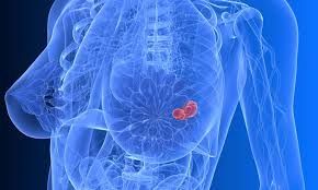 Metastatic Breast Cancer Treatment Market Trends Analysis 2028
