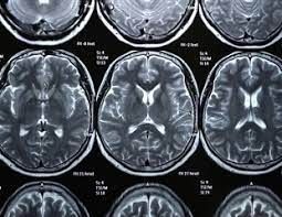 Micro-Magnetic Resonance Imaging Market: Industry Outlook Report 