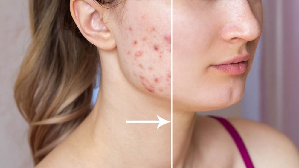 Micro-needling for acne scars: Cost vs. results