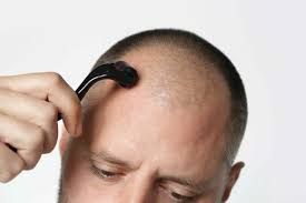 Microneedling for hair and skin: Here’s what you should know