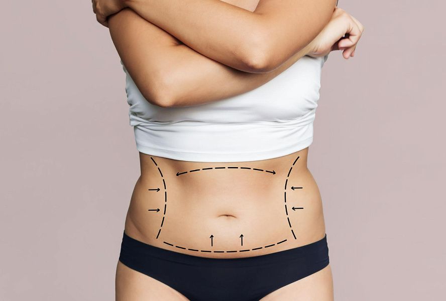 Mini Abdominoplasty in Dubai Expert Overview
