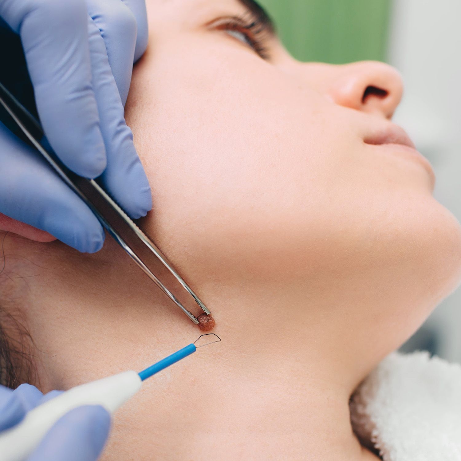 What is the best aftercare for mole removal?