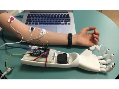 Myoelectric Prosthetics Market: Analysis, Size, Share 2030