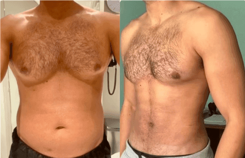 Expert Gynecomastia Surgery in Dubai for Men Seeking Change