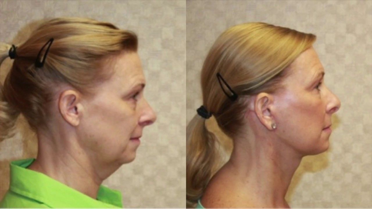 Neck Lift Surgery in Dubai Safe Procedure Insights