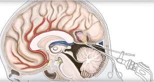 Neuroendoscopy Market Latest Analysis Report Upto 2028