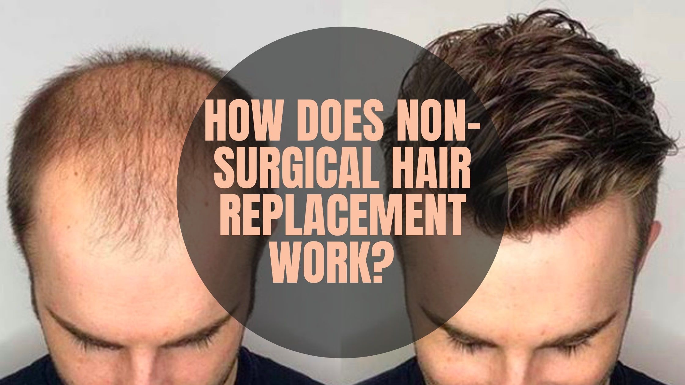 What Is Non-Surgical Hair Replacement?