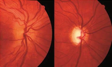 Optic Neuropathy Drug Market Size 2021–2028
