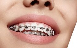 All You Need to Know About Orthodontics Treatment
