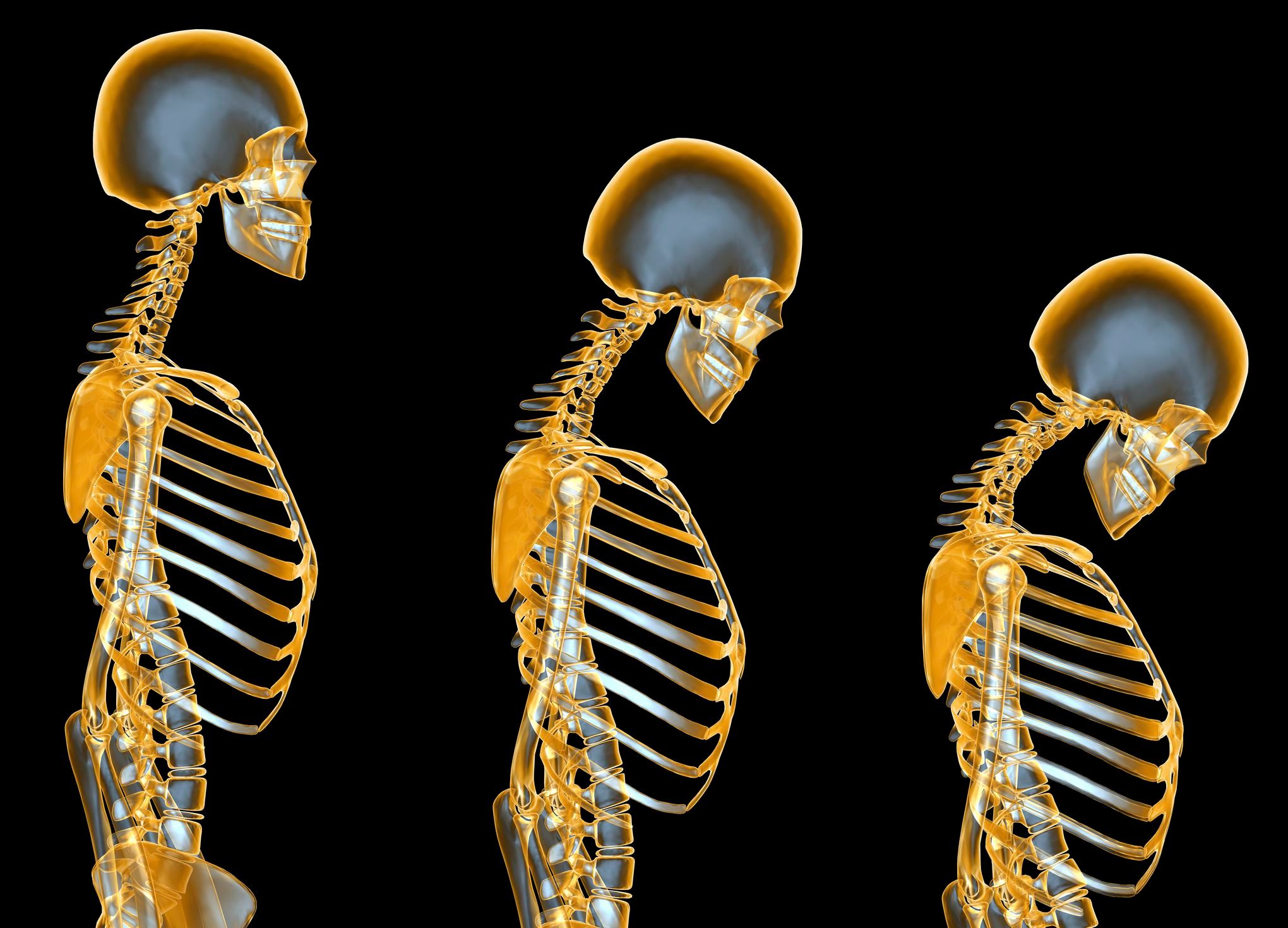 Osteoporosis Market Size, Key Players Analysis & Forecast to 2028