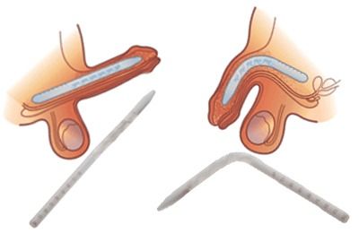 Exploring Surgical and Non-Surgical Options for Penile Enlargement