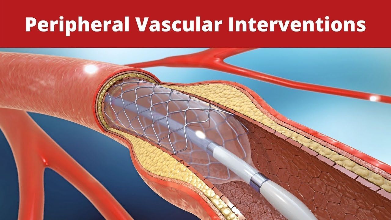Peripheral Interventions Market Forecast Report to 2028