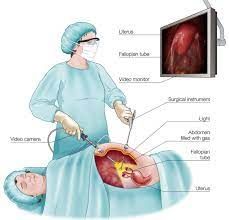 Peritoneoscopes Market Outlook, to 2030