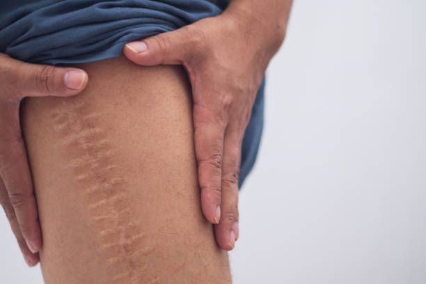 Scar Treatment That Restores Your Skin and Self-Esteem