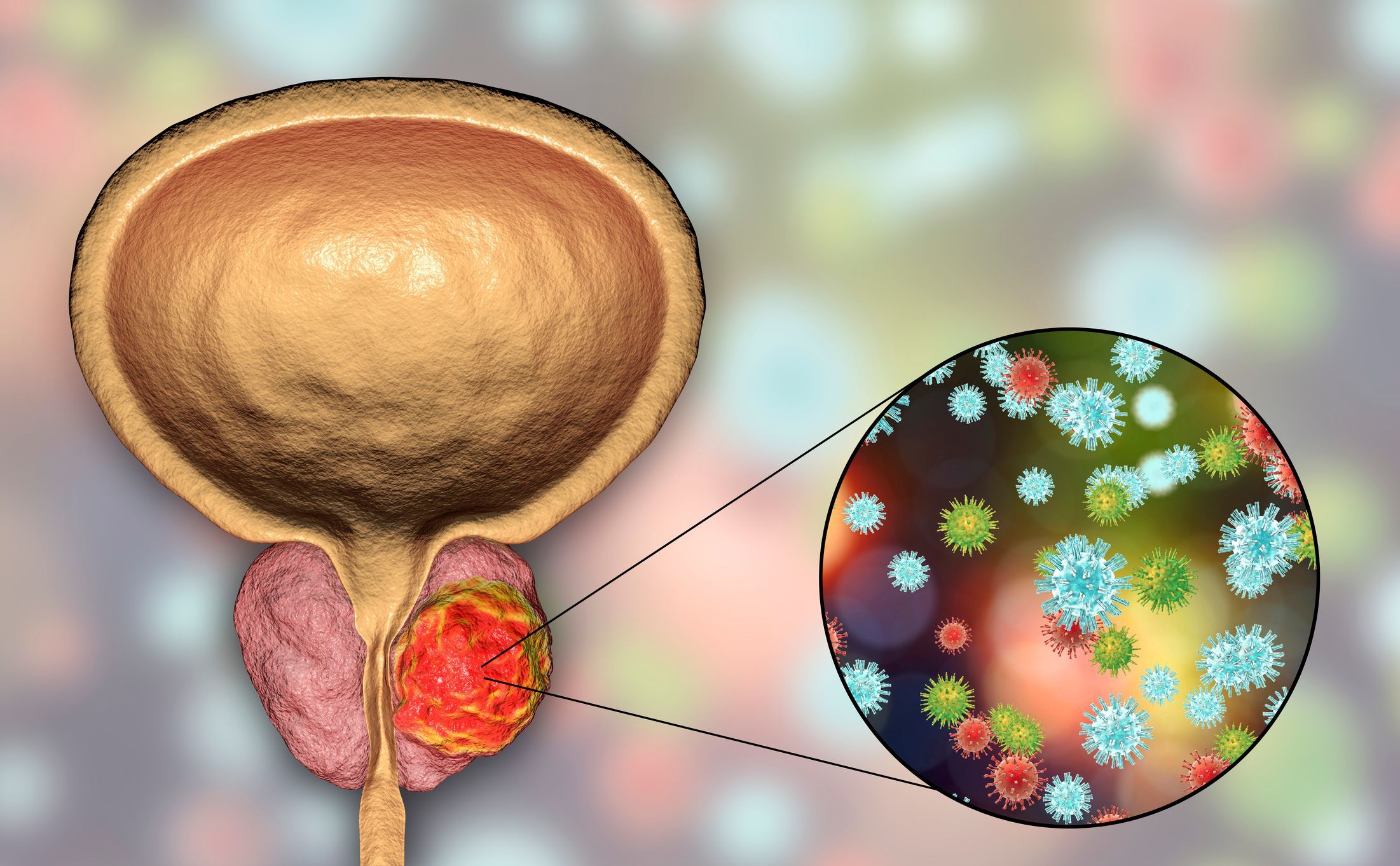 Prostate Cancer Therapeutics Market : Covid-19 Impact Analysis