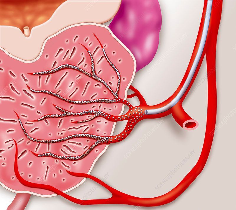 Prostatic Artery Embolization Market Key Players  Report to 2028