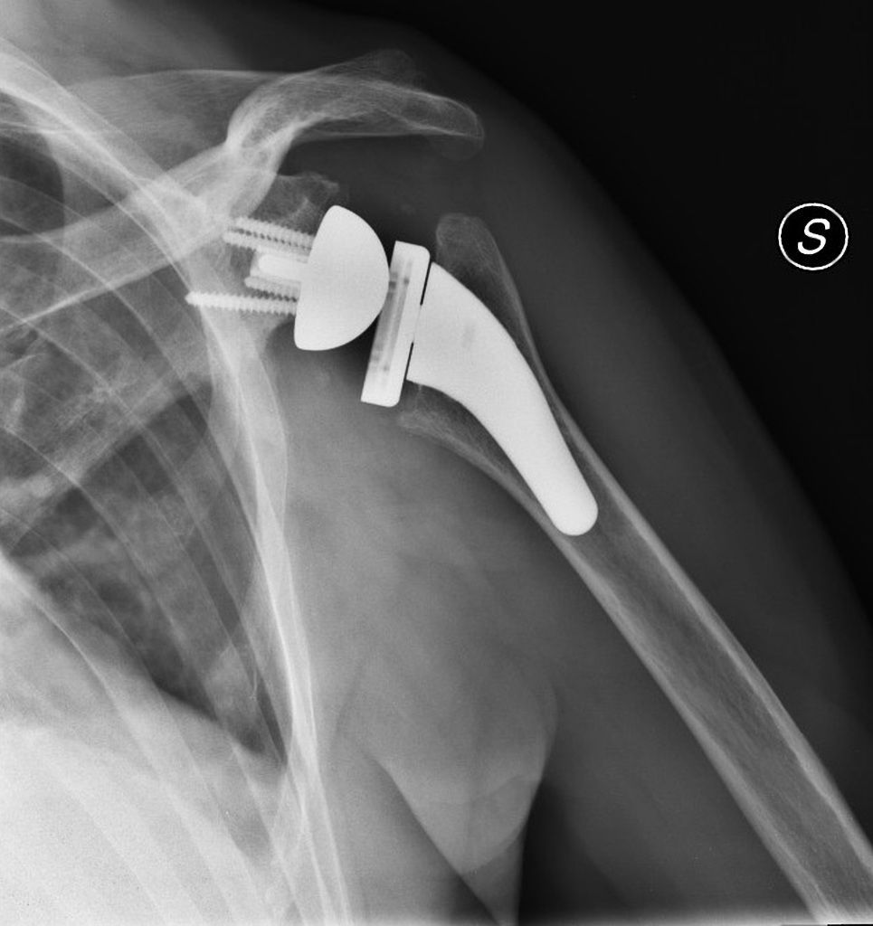Reverse Shoulder Arthroplasty Market Forecast Report to 2028