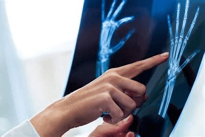 Rheumatoid Arthritis Diagnostic Tests Market Size Report to 2028