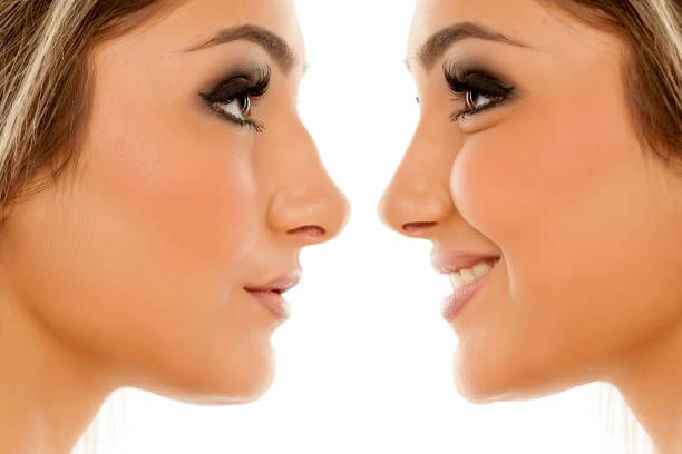 Rhinoplasty Surgery in Riyadh: Common Myths Debunked