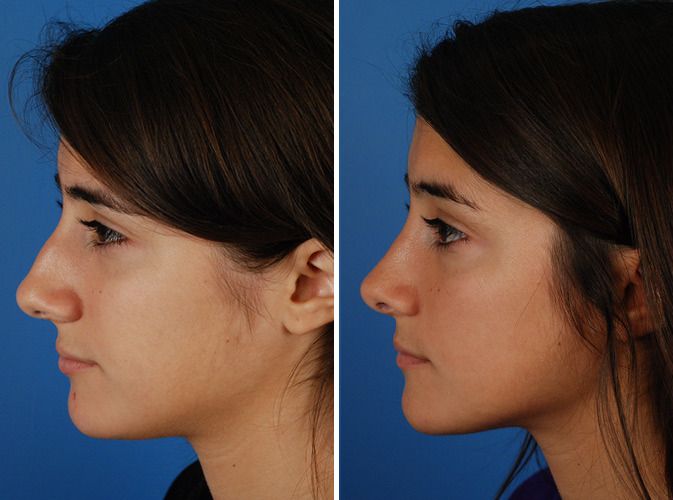 Rhinoplasty in Dubai Natural Nose Shape Improvement Guide