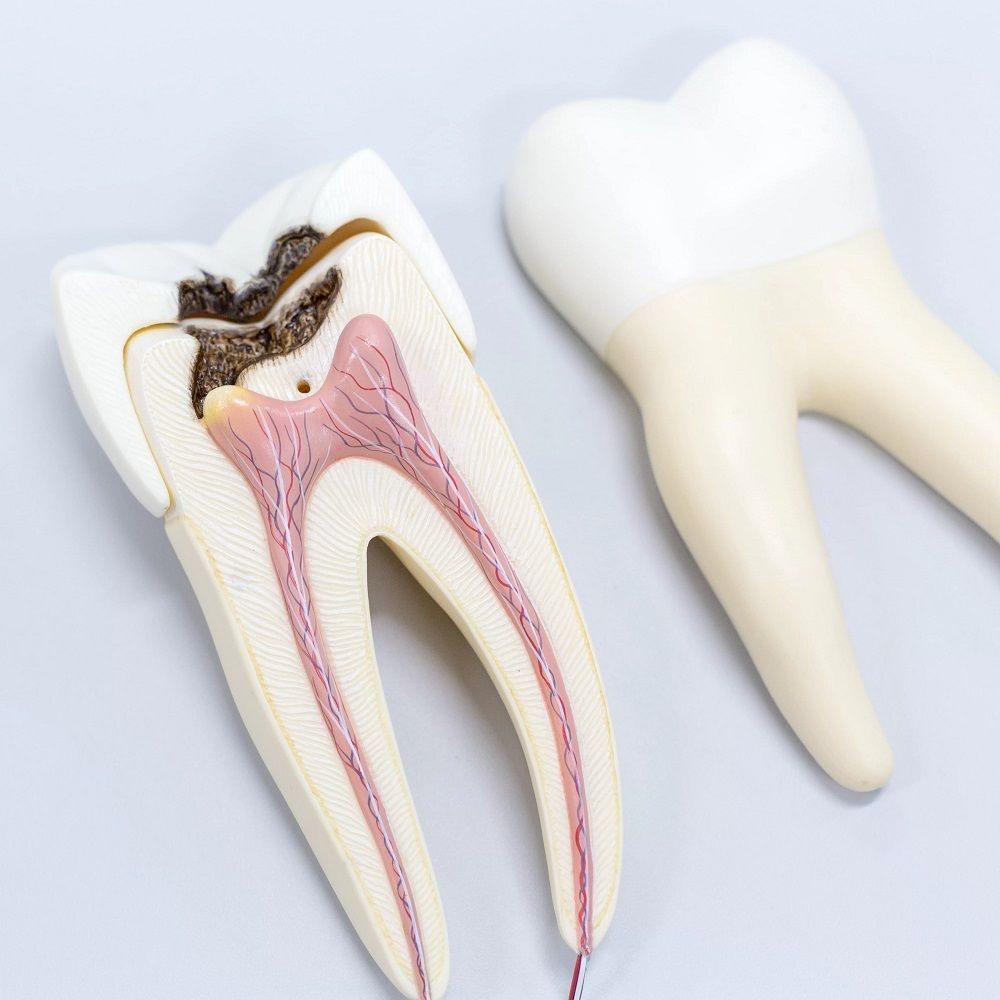 What material is used for root canal filling?