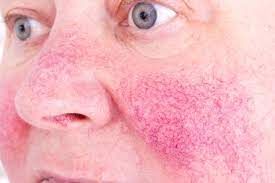 Rosacea Therapeutics Market Size, Share - Industry Report 2028