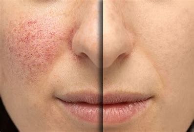 Rosacea Treatment Market Overview Survey 2022 to 2028
