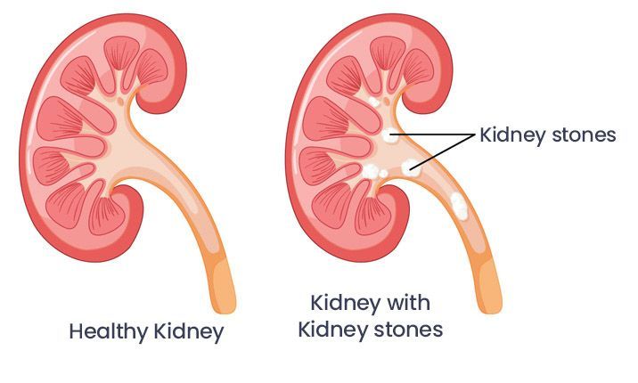 What Size of Kidney Stone Requires Surgery?  