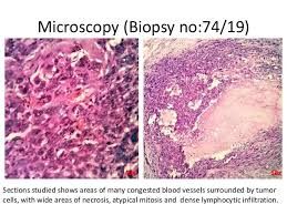 Sarcoma Biopsy Market Size & Global Forecast to 2028

