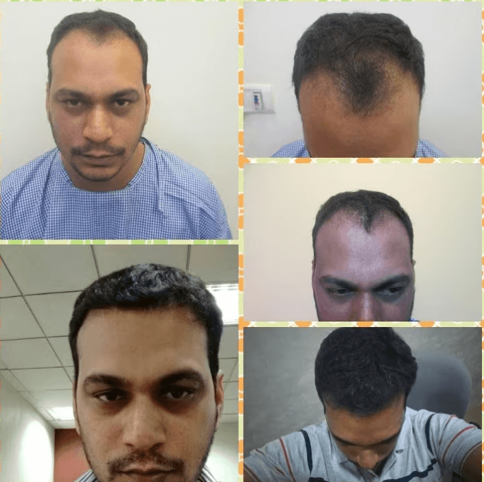 Hair Transplantation in Lucknow- Dr Disha's Hair & Skin Clinic