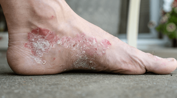 Understanding Eczema and Tips for Managing Its Symptoms 