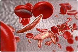 Sickle Cell Anemia Market Growth | Research Report, 2028