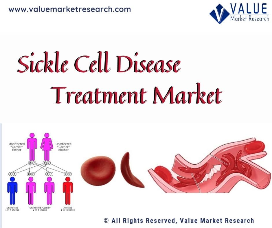Sickle Cell Disease Treatment Market Share, Forecast Report