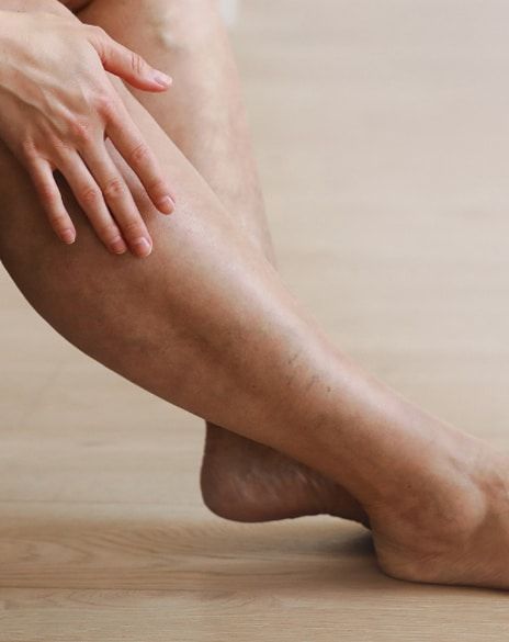 Can Exercise Help Reduce Spider Veins? Expert Tips from Islamabad