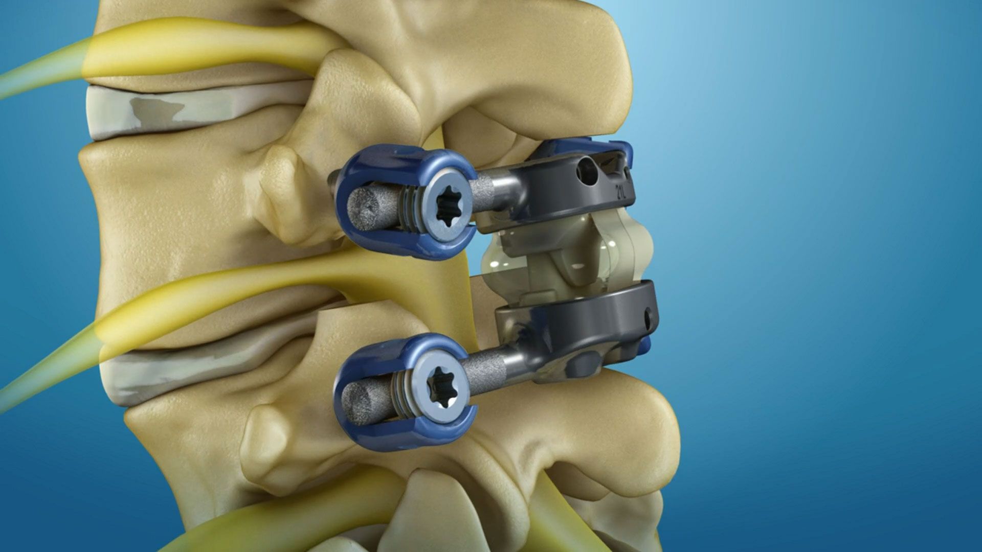 2028 Spinal Implant Market: Future Growth and Opportunities 
