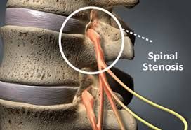 Spinal Stenosis Market 2022 Size, Growth Factors & Forecast 2028
