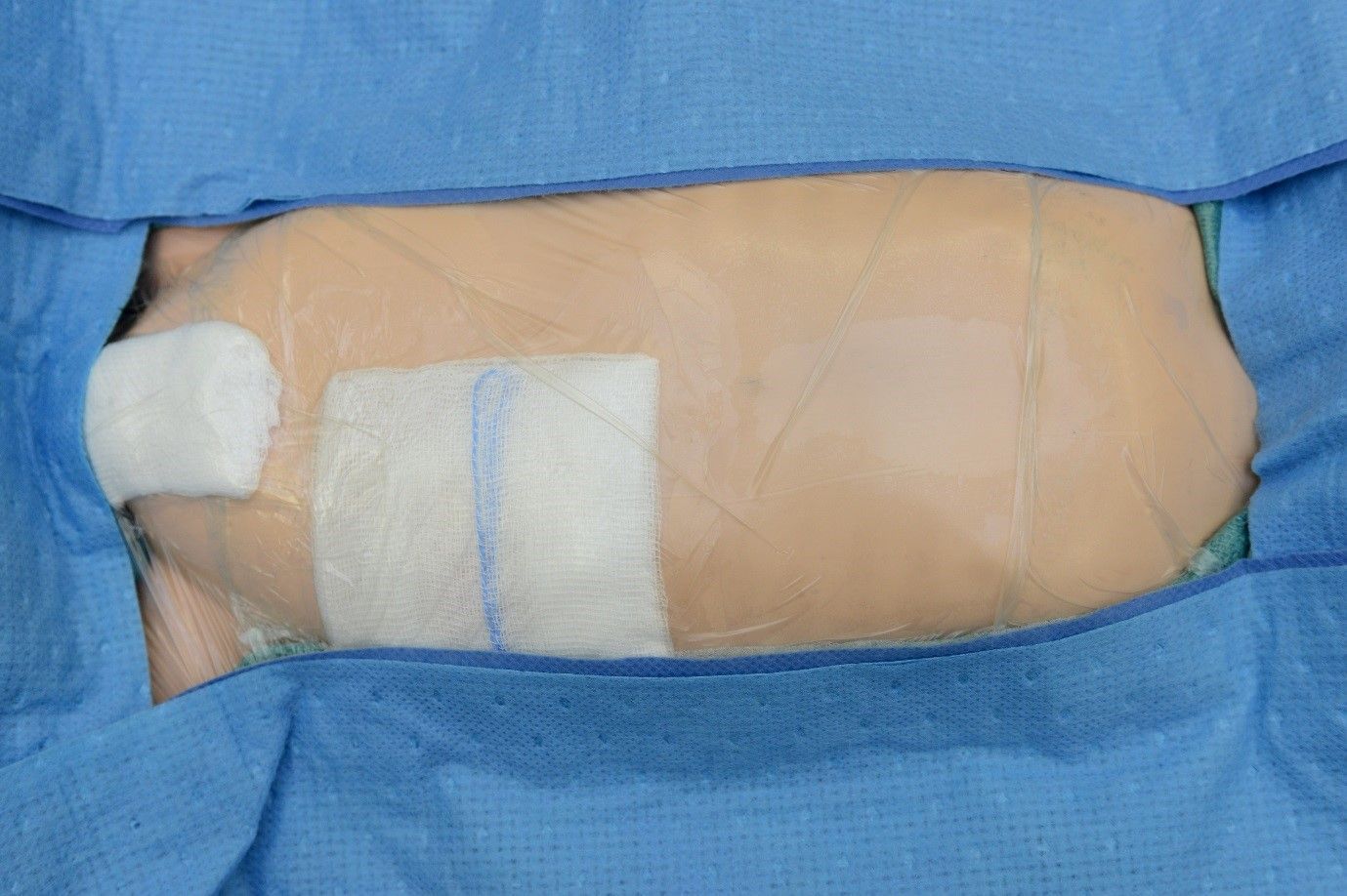 Stoma/ostomy Care Market Outlook, Growth and Forecast 2022-2027
