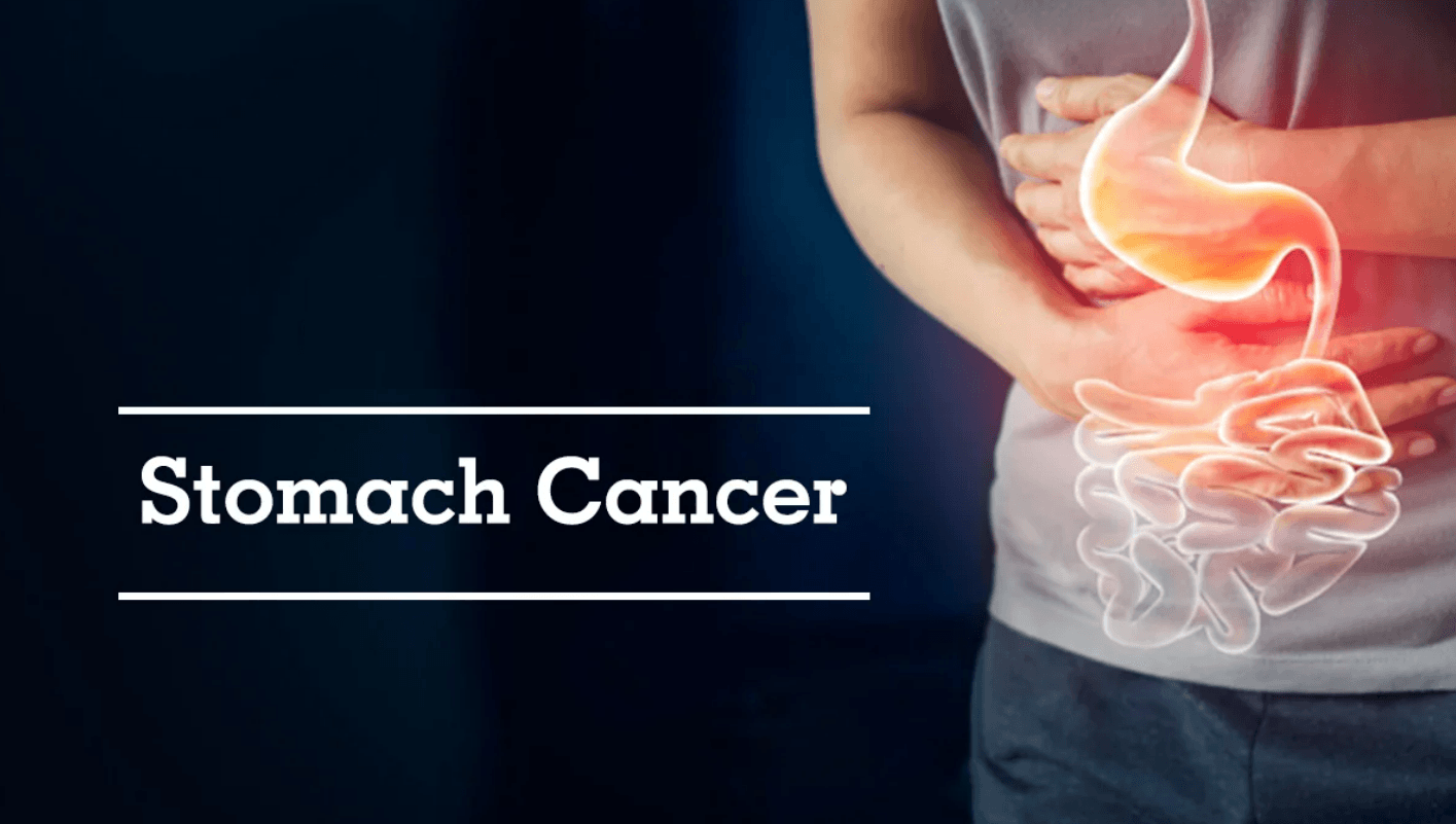 Stomach Cancer Treatment Market 2022 Growth Factors & Forecast 