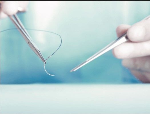 Surgical Sutures Market Global Industry Analysis, Forecast 2030