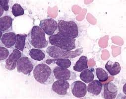 T-Cell Acute Lymphoblastic Leukemia Market Outlook Report 

