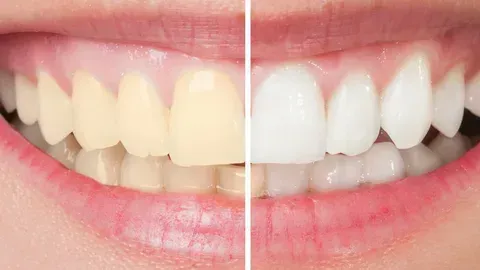 The Ultimate Guide to Teeth Whitening
