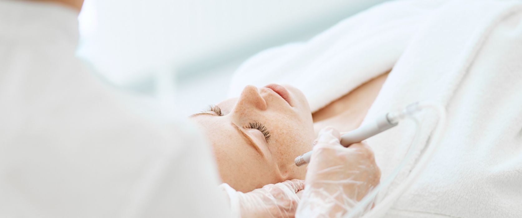 Top 5 Benefits of Getting a Chemical Peeling